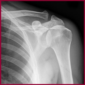 Shoulder X-ray